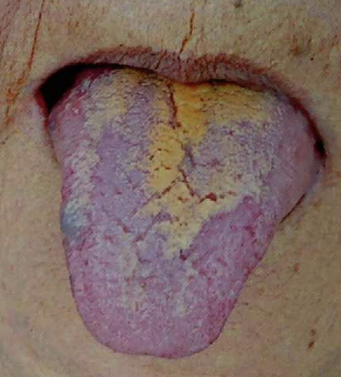 열로 인한 진액손상 설 사진