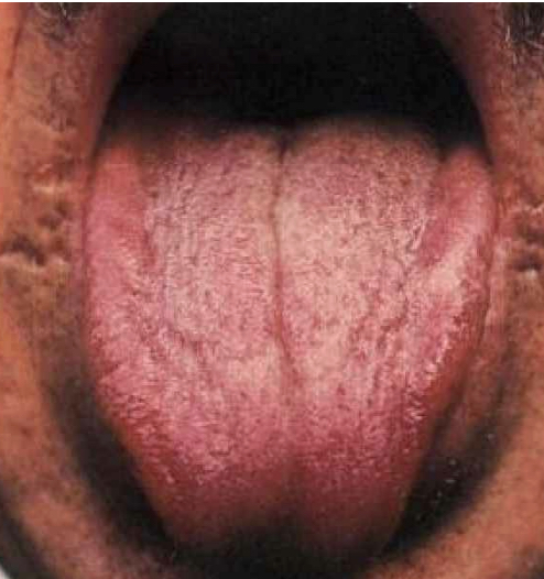 음허로 인한 허열 설 사진